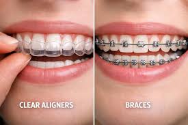 Braces & Aligners